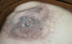 乳腺癌图片,乳腺癌早期症状与外观特征解析